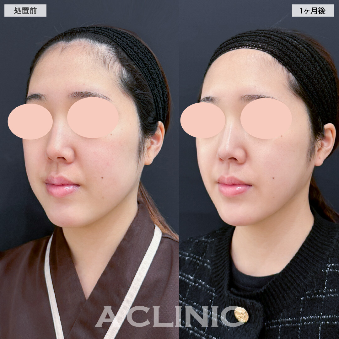 1day小顔脂肪吸引とバッカルファット除去術とナゾラビアルファット除去術で輪郭のボリュームを大幅にダウン！処置前と1ヶ月後の症例です(20代女性)