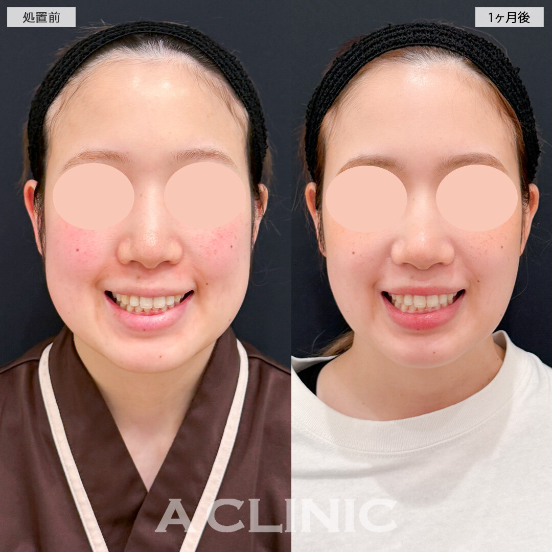 1day小顔脂肪吸引とバッカルファット除去術と小顔エラボトックスでお顔の余白を大幅に減らせました！処置前と1ヶ月後の症例です(30代女性)