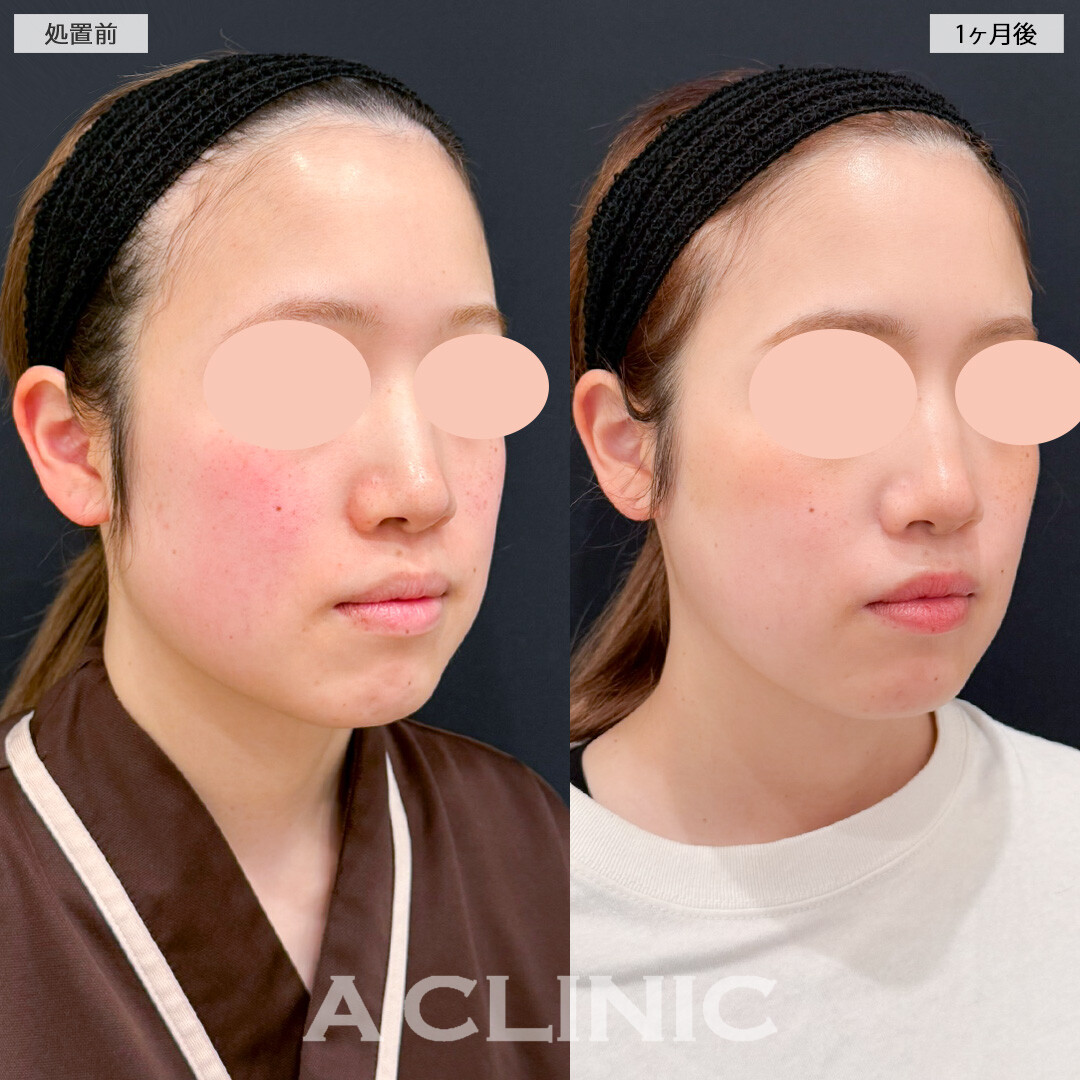 1day小顔脂肪吸引とバッカルファット除去術と小顔エラボトックスでお顔の余白を大幅に減らせました！処置前と1ヶ月後の症例です(30代女性)