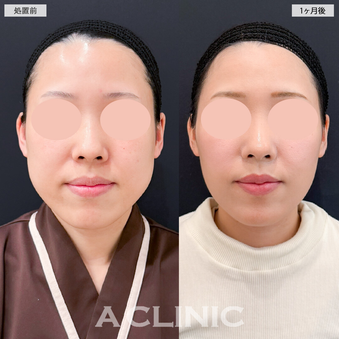 1day小顔脂肪吸引とバッカルファット除去術で痩せても減らない口横の脂肪も一発で解消！処置前と1ヶ月後の症例です(30代女性)