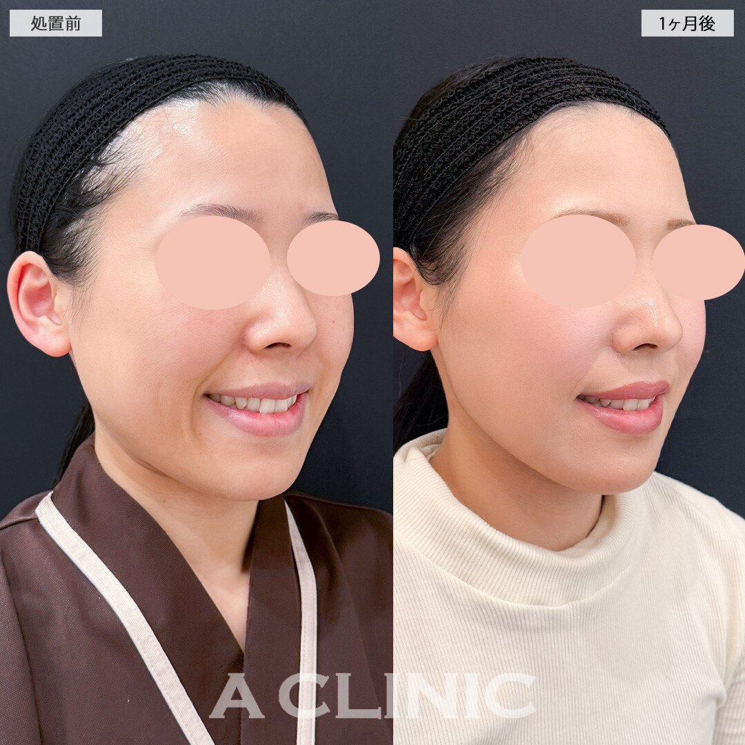 1day小顔脂肪吸引とバッカルファット除去術で痩せても減らない口横の脂肪も一発で解消！処置前と1ヶ月後の症例です(30代女性)