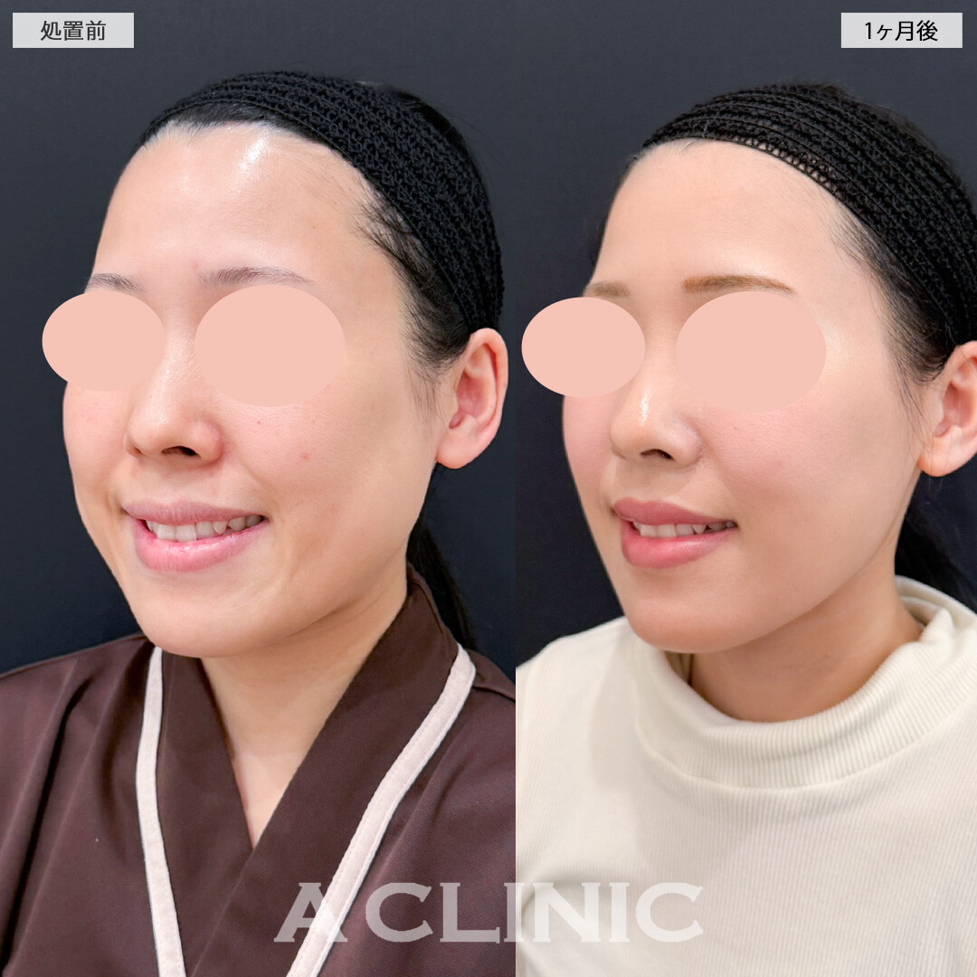 1day小顔脂肪吸引とバッカルファット除去術で痩せても減らない口横の脂肪も一発で解消！処置前と1ヶ月後の症例です(30代女性)