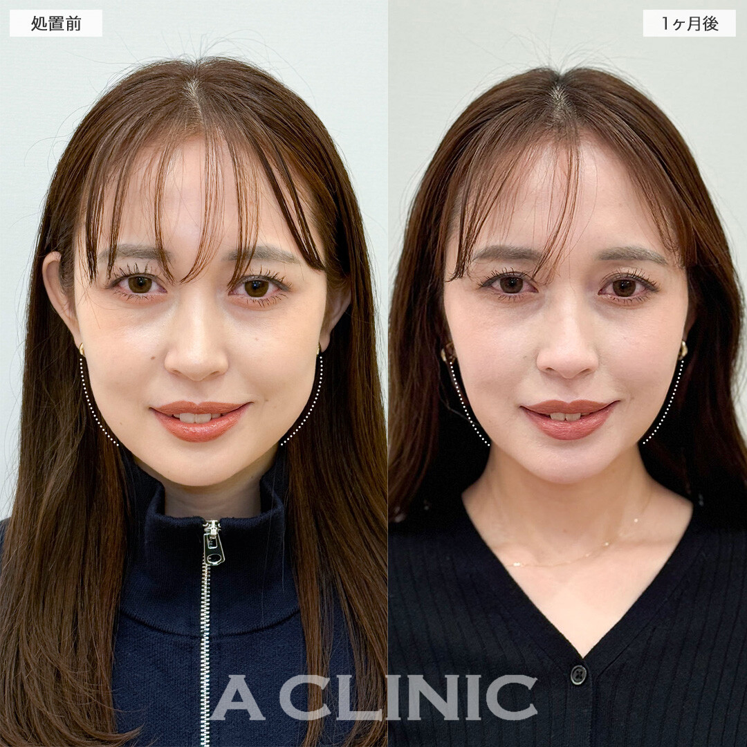 1day小顔脂肪吸引とバッカルファット除去術で頬の膨らみを解消！こちら処置前と1ヶ月後の症例です(30代女性)