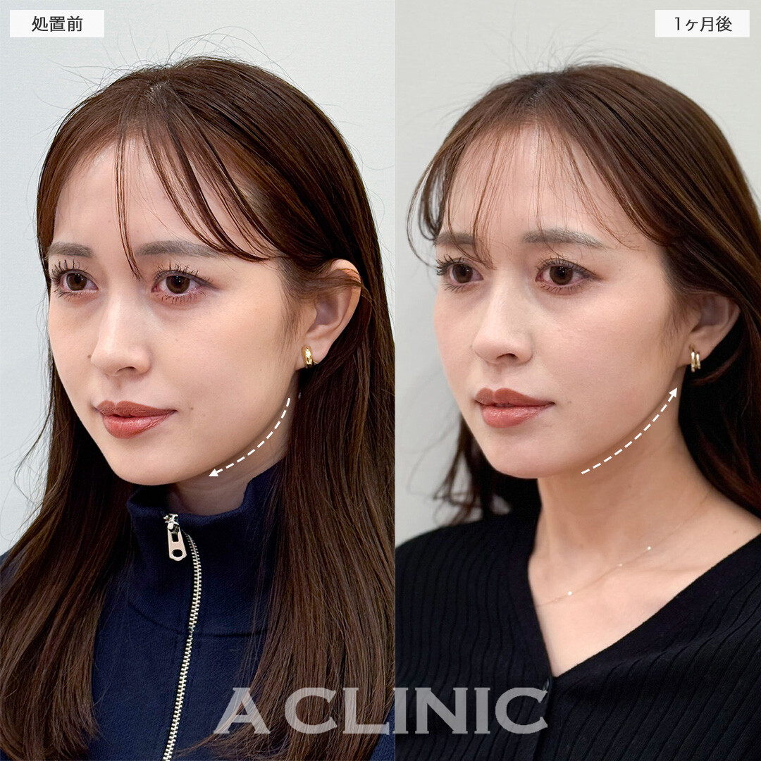 1day小顔脂肪吸引とバッカルファット除去術で頬の膨らみを解消！こちら処置前と1ヶ月後の症例です(30代女性)