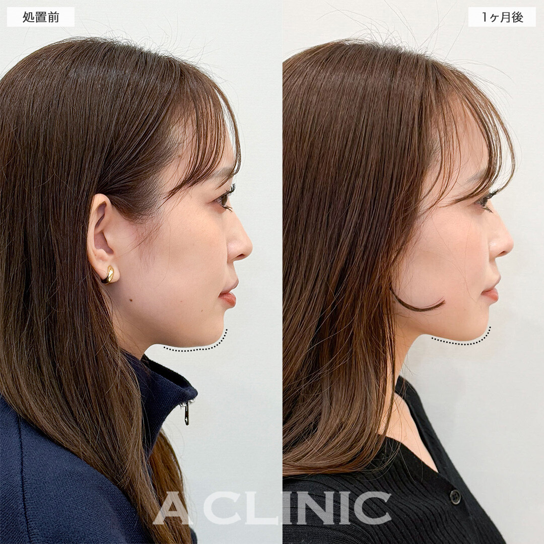 1day小顔脂肪吸引とバッカルファット除去術で頬の膨らみを解消！こちら処置前と1ヶ月後の症例です(30代女性)