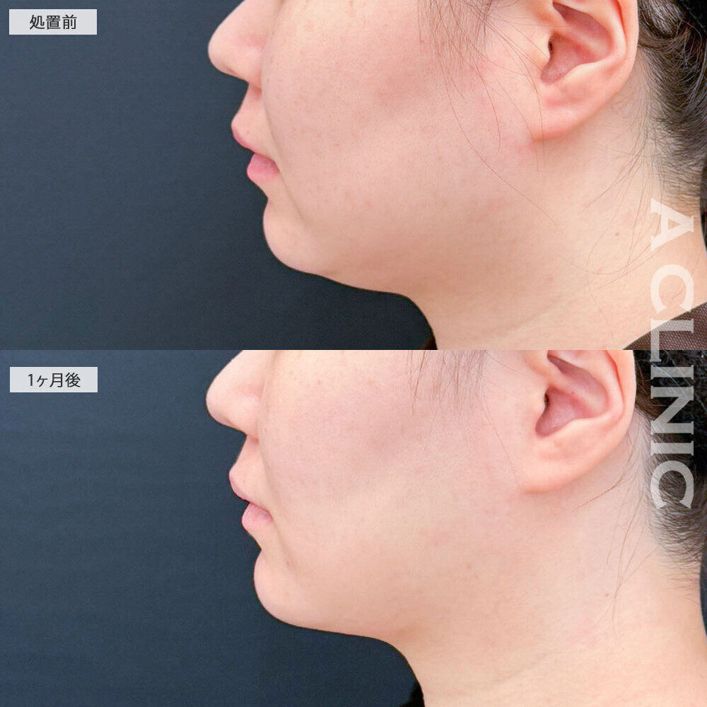 1day小顔脂肪吸引とバッカルファット除去術でどこから見てもひと回り小顔に！処置前と1ヶ月後の症例です(20代女性)