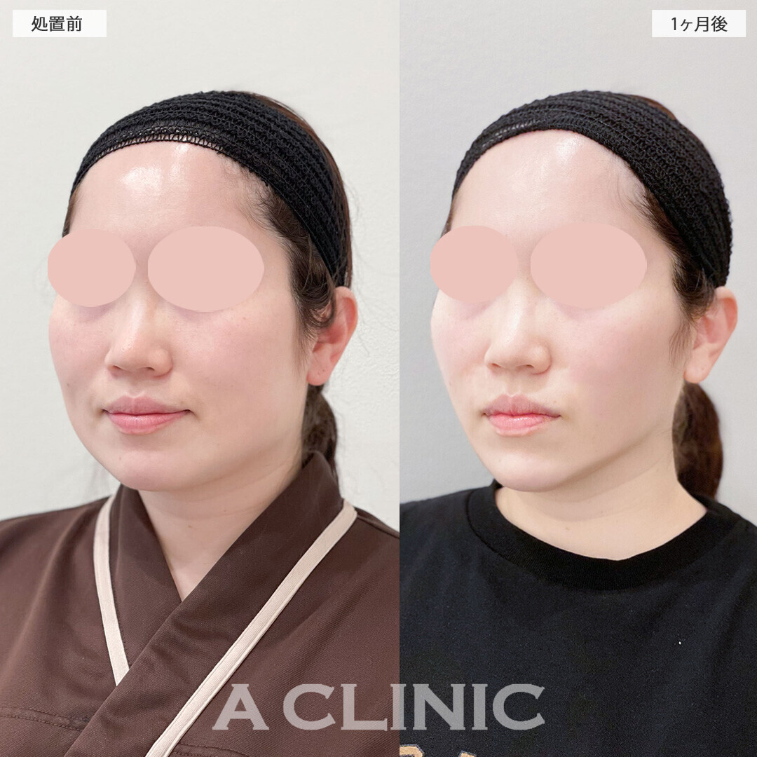 1day小顔脂肪吸引で下膨れが改善されました！処置前と1ヶ月後の症例です(30代女性)