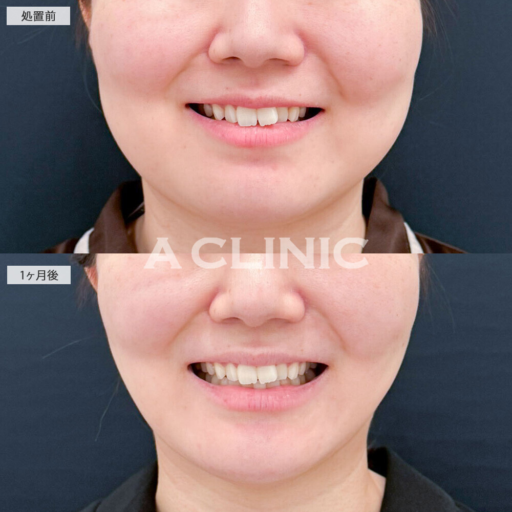 1day小顔脂肪吸引とバッカルファット除去術でどこから見てもひと回り小顔に！処置前と1ヶ月後の症例です(20代女性)