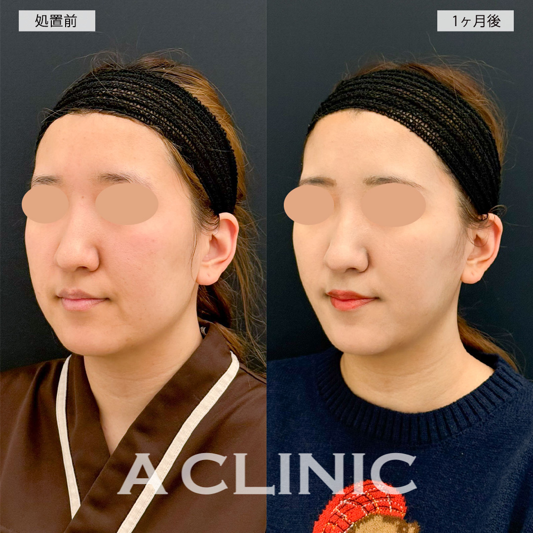 1day小顔脂肪吸引で輪郭のもたつきが無くなりダイエット無しでも痩せた印象に！こちら処置前と1ヶ月後の症例です(20代女性)