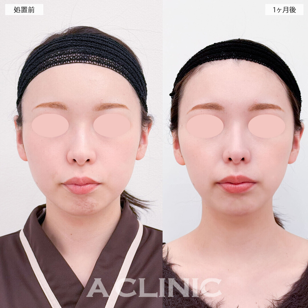 1day小顔脂肪吸引と小顔エラボトックスとあごへのヒアルロン酸注入で丸顔改善！処置前と1ヶ月後の症例です(20代女性)