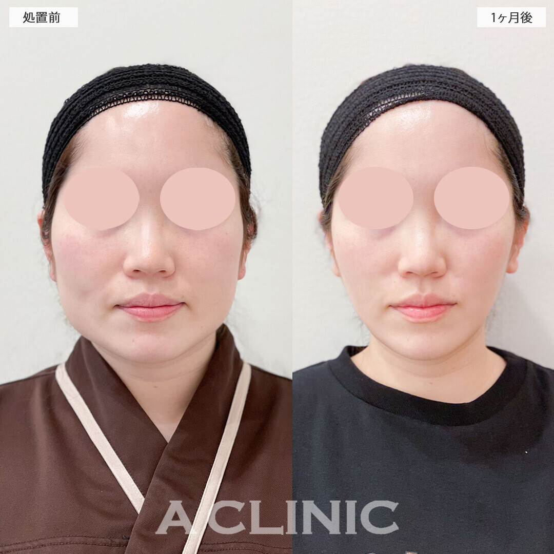1day小顔脂肪吸引で下膨れが改善されました！処置前と1ヶ月後の症例です(30代女性)