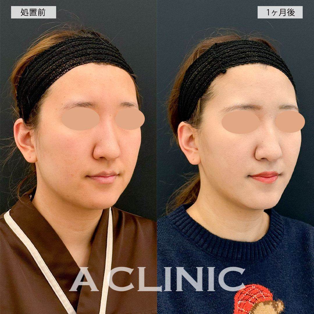 1day小顔脂肪吸引で輪郭のもたつきが無くなりダイエット無しでも痩せた印象に！こちら処置前と1ヶ月後の症例です(20代女性)
