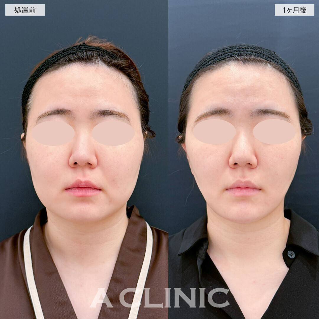 1day小顔脂肪吸引とバッカルファット除去術でどこから見てもひと回り小顔に！処置前と1ヶ月後の症例です(20代女性)
