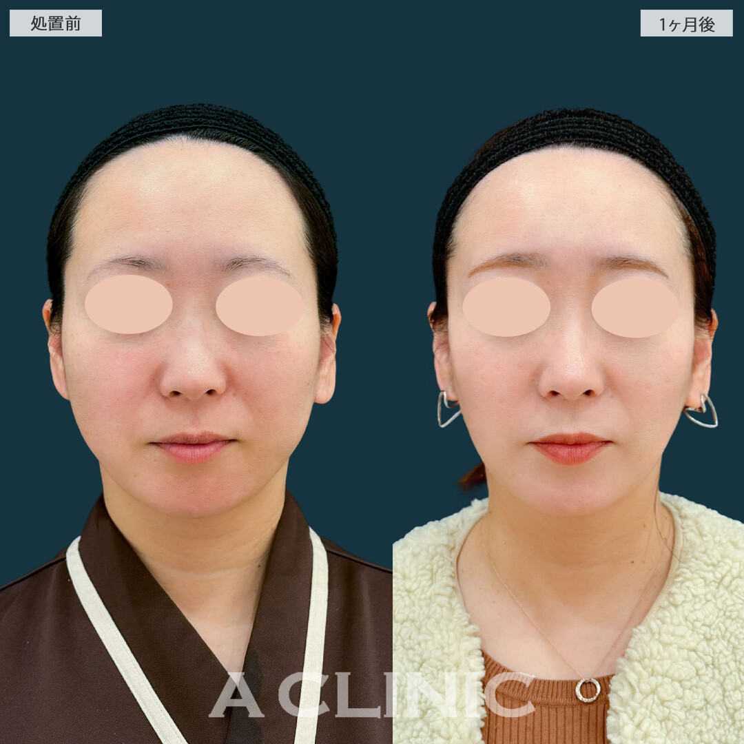 1day小顔脂肪吸引とバッカルファット除去術で気になるフェイスラインの膨らみを除去！こちら処置前と1ヶ月後の症例です(40代女性)