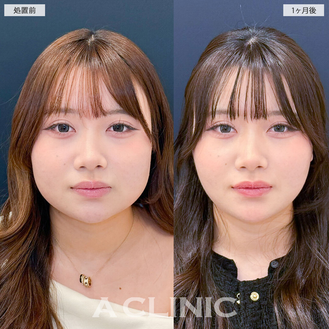 1day小顔で顔が一回り小さくなり加工いらずの輪郭に！こちら処置前と1ヶ月後の症例です(20代女性)