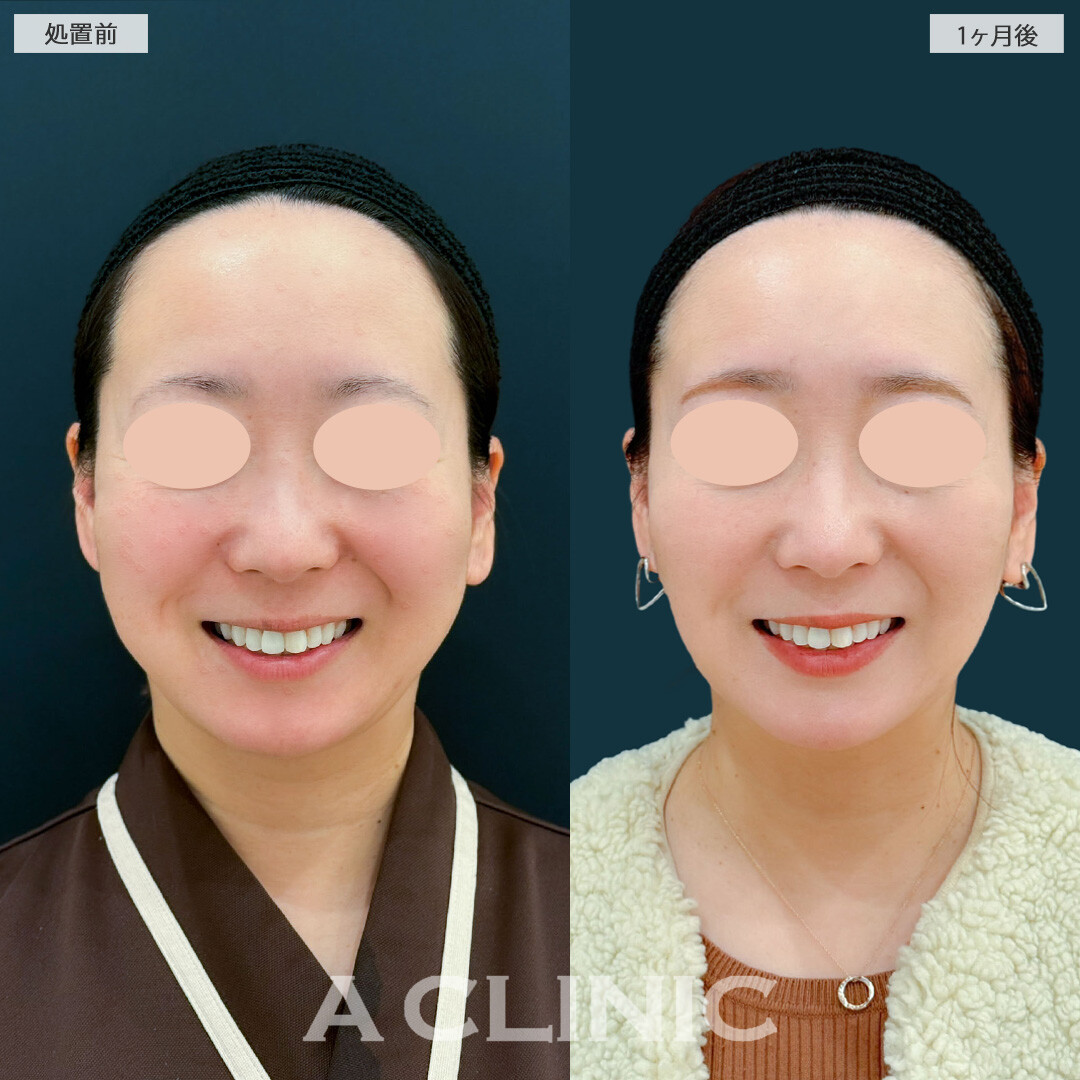 1day小顔脂肪吸引とバッカルファット除去術で気になるフェイスラインの膨らみを除去！こちら処置前と1ヶ月後の症例です(40代女性)