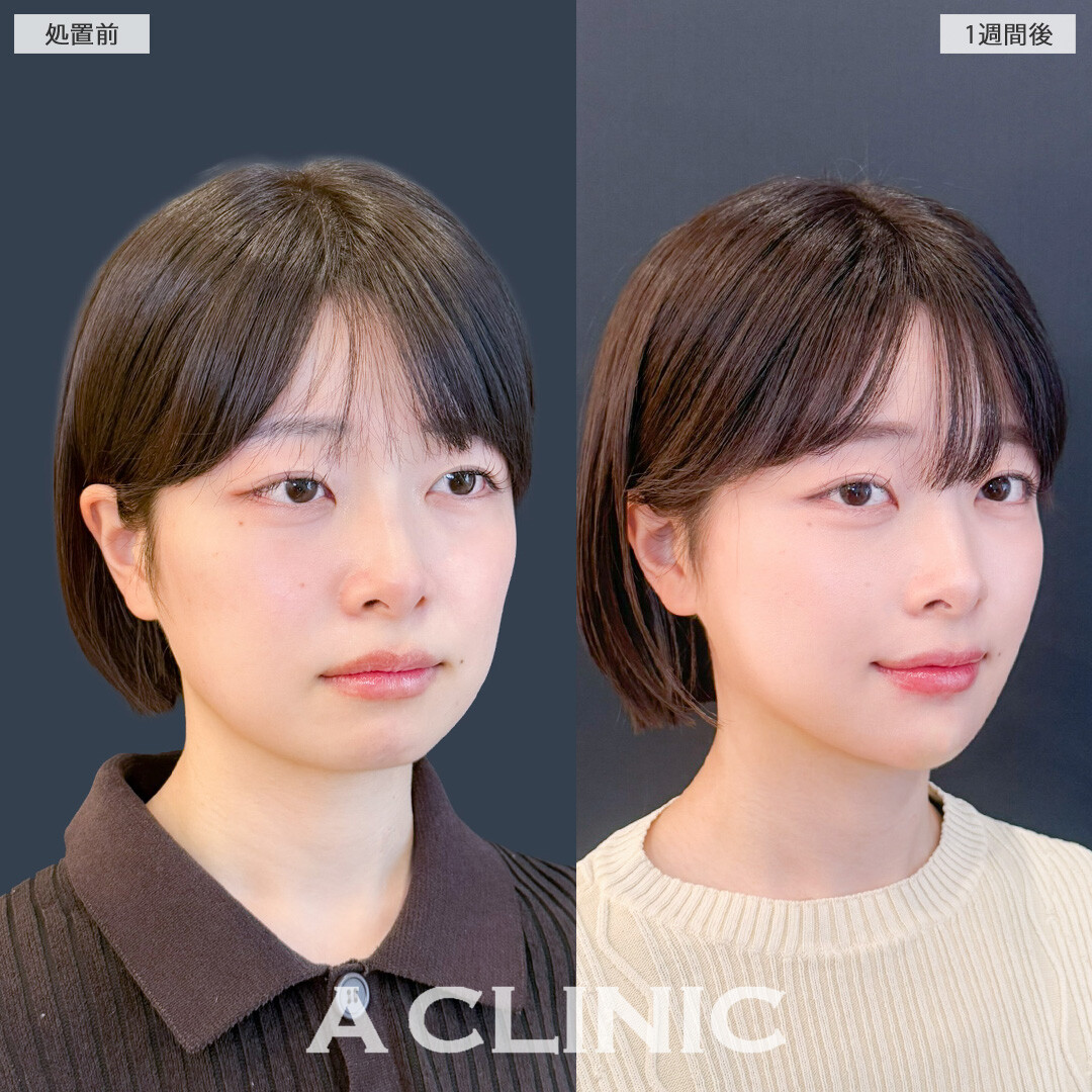 1day小顔脂肪吸引なら1週間後でもここまで腫れが少なくダウンタイム最小限！こちら処置前と1週間後の症例です(20代女性)