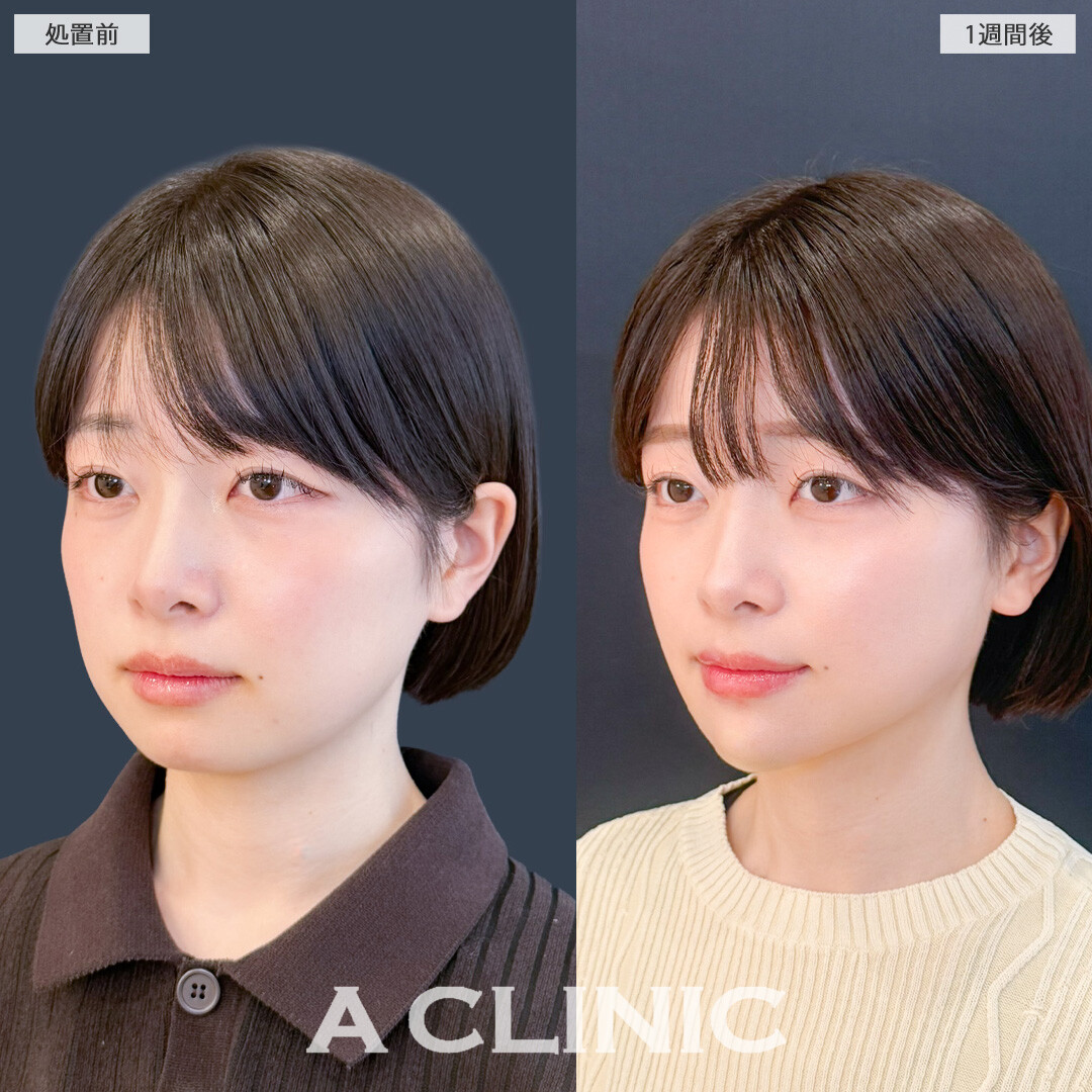1day小顔脂肪吸引なら1週間後でもここまで腫れが少なくダウンタイム最小限！こちら処置前と1週間後の症例です(20代女性)