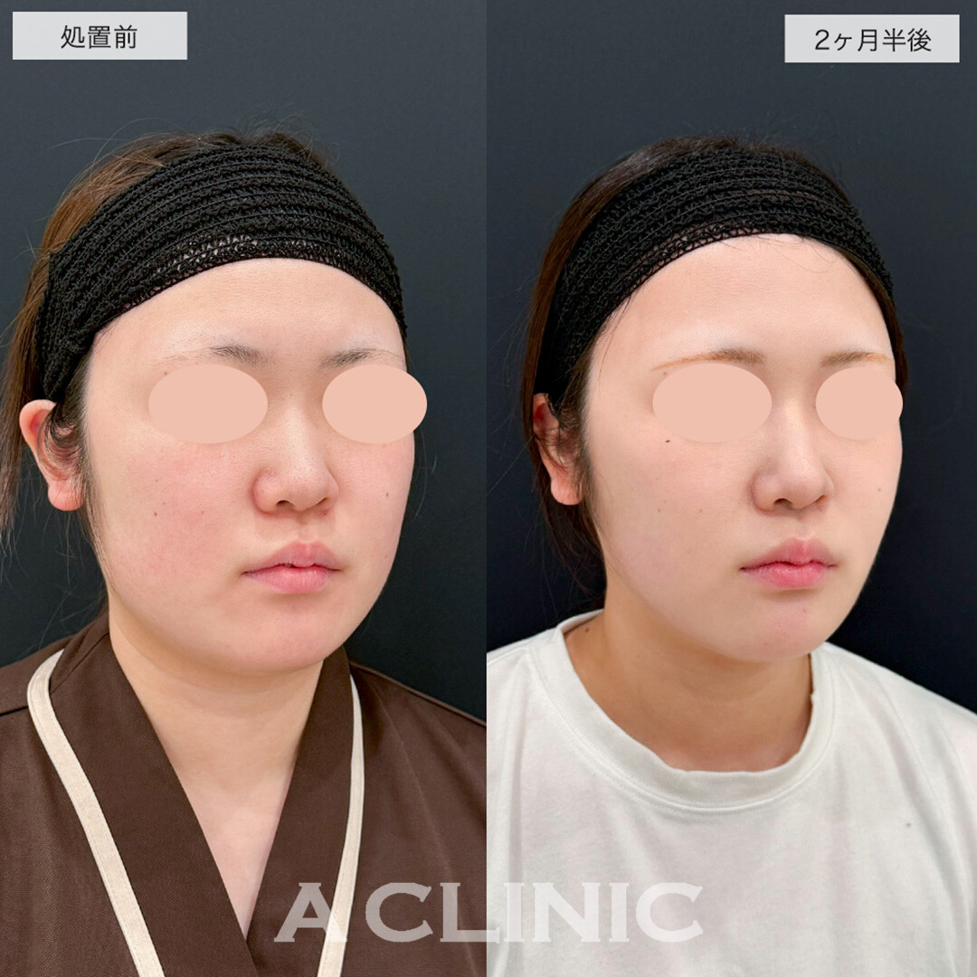 1day小顔脂肪吸引で顔の余白を除去しスッキリ小顔に!こちら処置前と2ヶ月半後の症例です(10代女性)