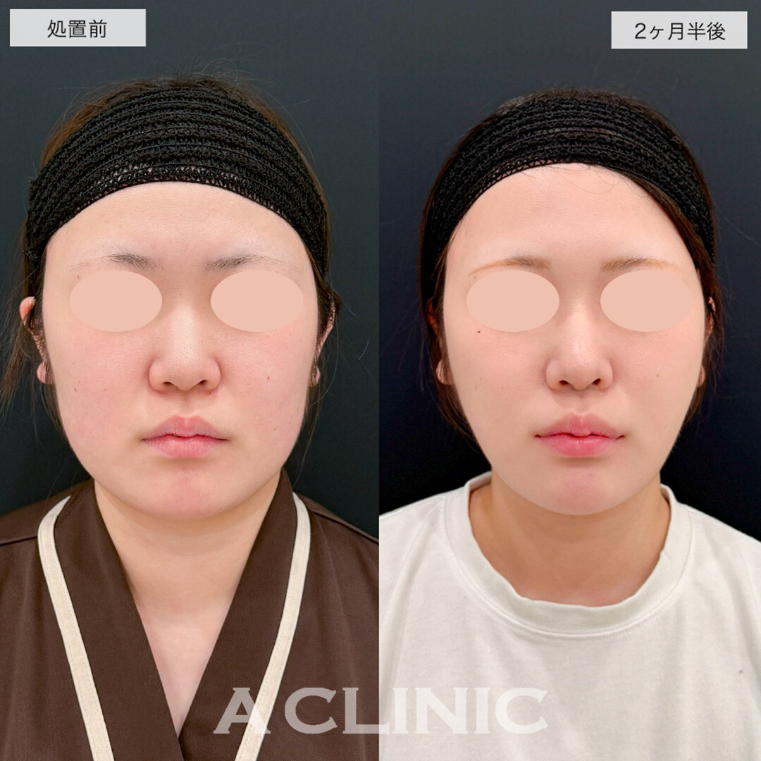 1day小顔脂肪吸引で顔の余白を除去しスッキリ小顔に!こちら処置前と2ヶ月半後の症例です(10代女性)