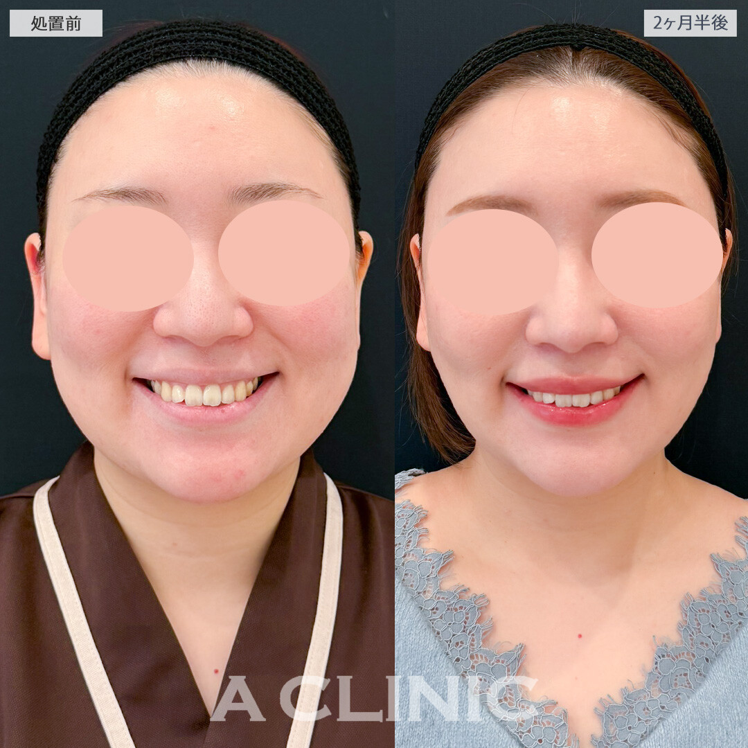 1day小顔脂肪吸引とバッカルファット除去術と小顔エラボトックスでダイエットで痩せにくい部分を細くできました！処置前と２ヶ月半後の症例です(30代女性)