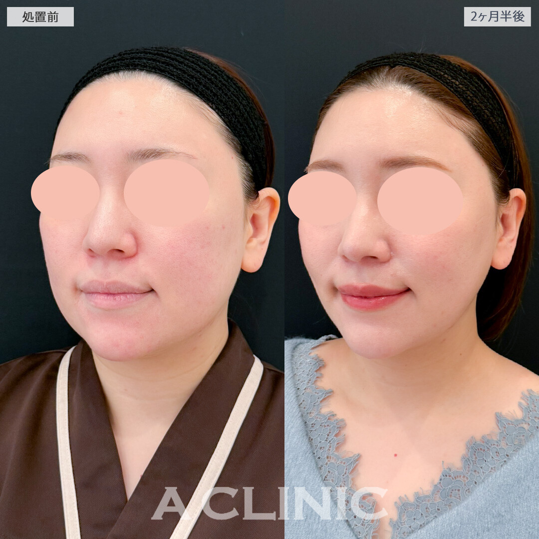 1day小顔脂肪吸引とバッカルファット除去術と小顔エラボトックスでダイエットで痩せにくい部分を細くできました！処置前と２ヶ月半後の症例です(30代女性)