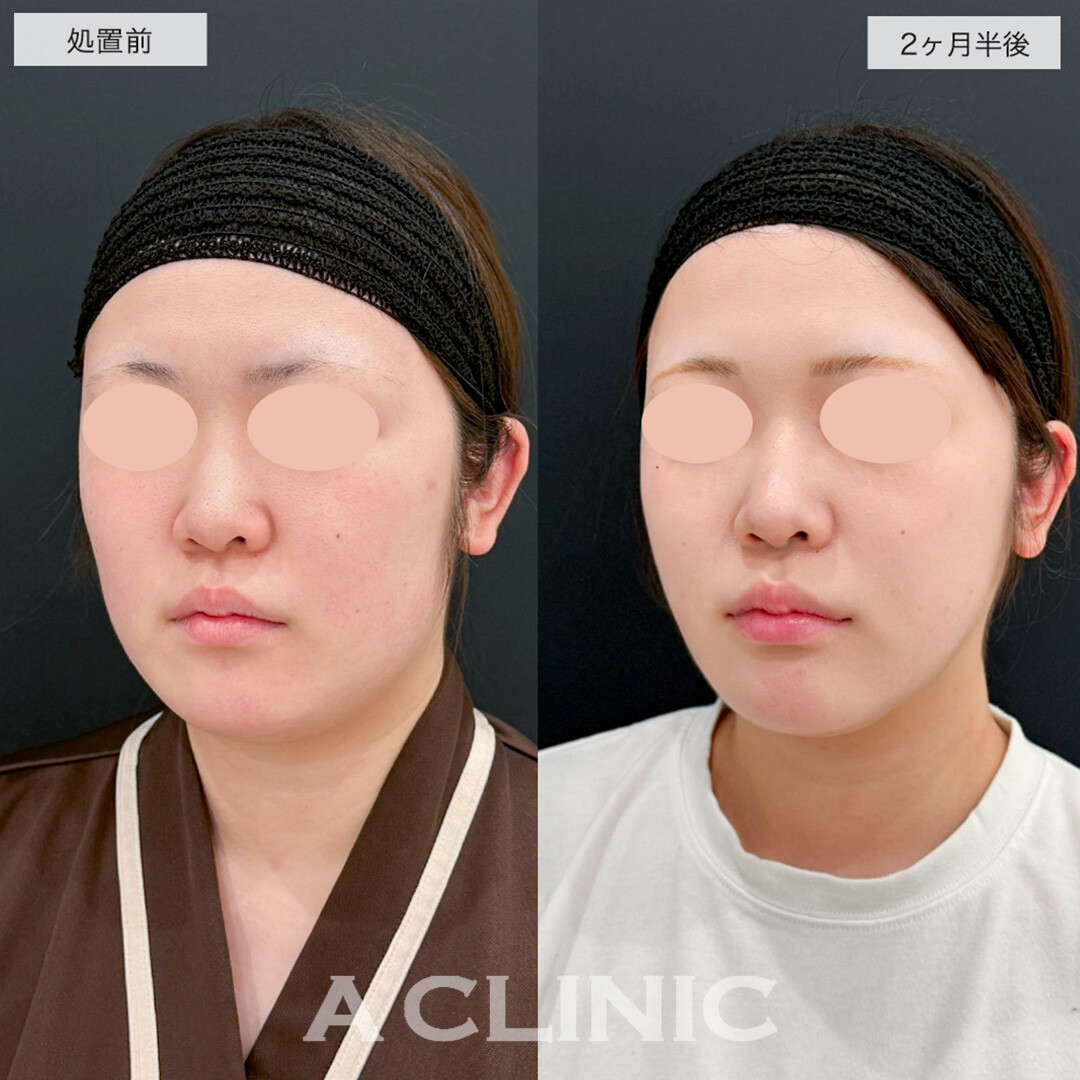 1day小顔脂肪吸引で顔の余白を除去しスッキリ小顔に!こちら処置前と2ヶ月半後の症例です(10代女性)