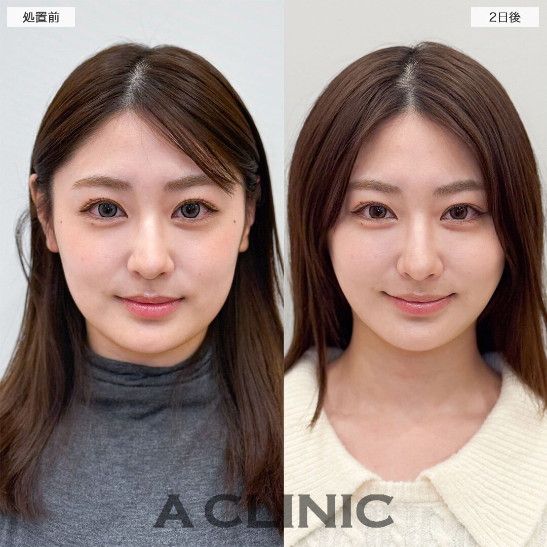1day小顔脂肪吸引ならダウンタイム最小限で効果を実感できる！こちら処置前と2日後の症例です(20代女性)