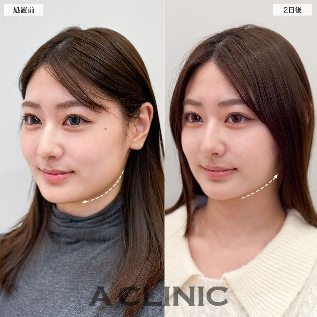 1day小顔脂肪吸引ならダウンタイム最小限で効果を実感できる！こちら処置前と2日後の症例です(20代女性)