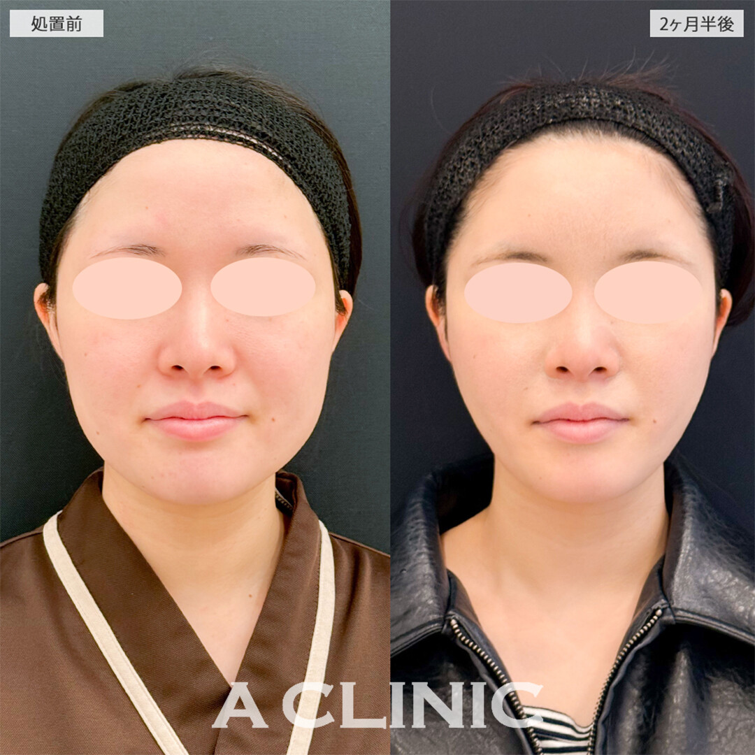 1day小顔脂肪吸引と小顔エラボトックスで一回り顔が小さくなりました！こちら処置前と2ヶ月半後の症例です(20代女性)