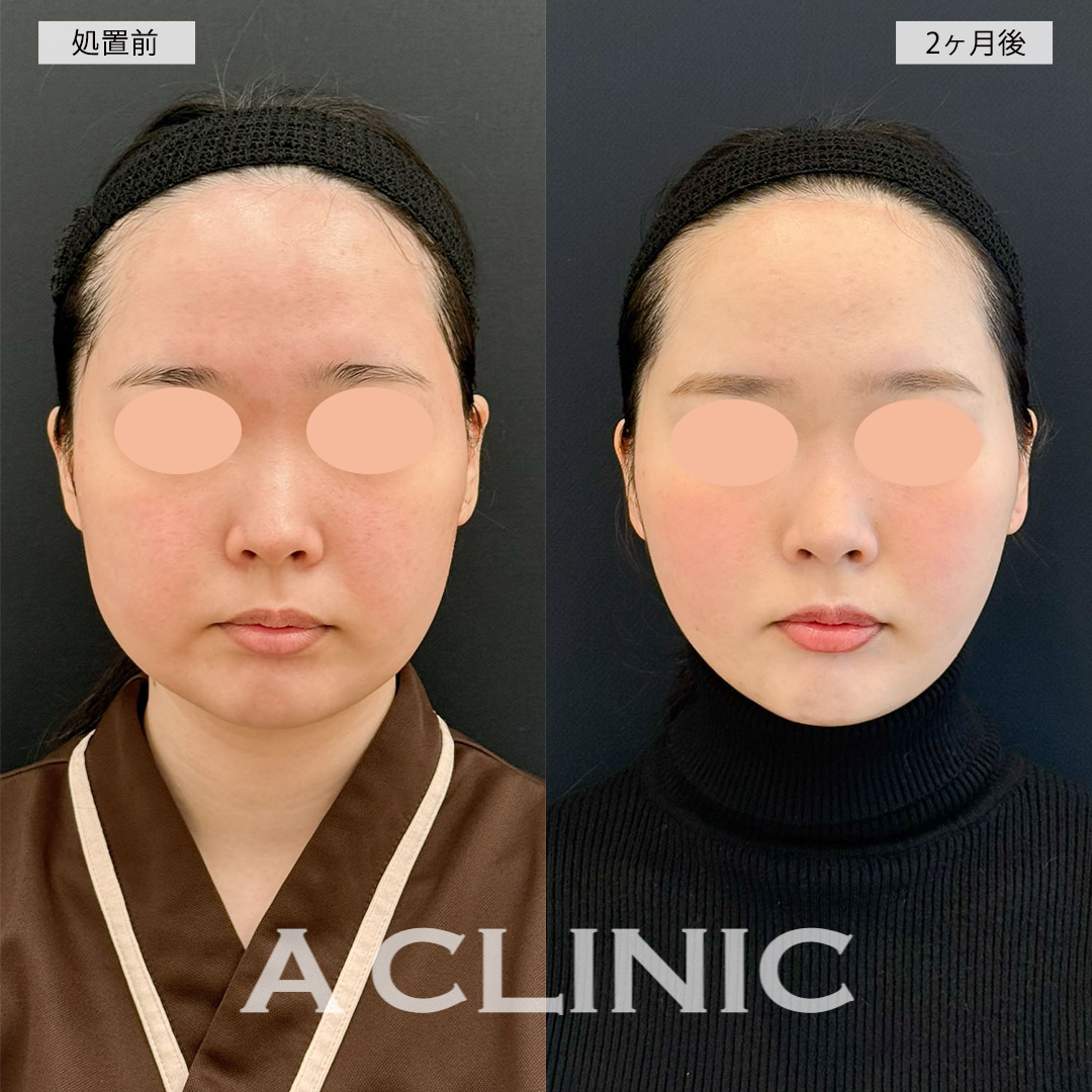 1day小顔脂肪吸引でお顔が一回り以上小さくなり自信が持てるようになりました！こちら処置前と2ヶ月後の症例です(20代女性)