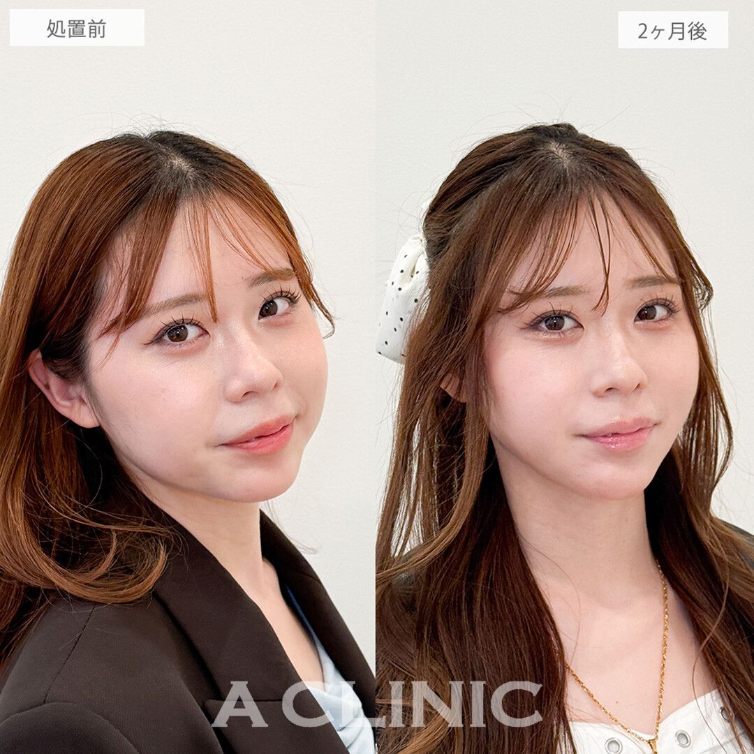 1day小顔脂肪吸引とあごへのヒアルロン酸注入で横顔のコンプレックス解消！こちら処置前と2ヶ月後の症例です(20代女性)