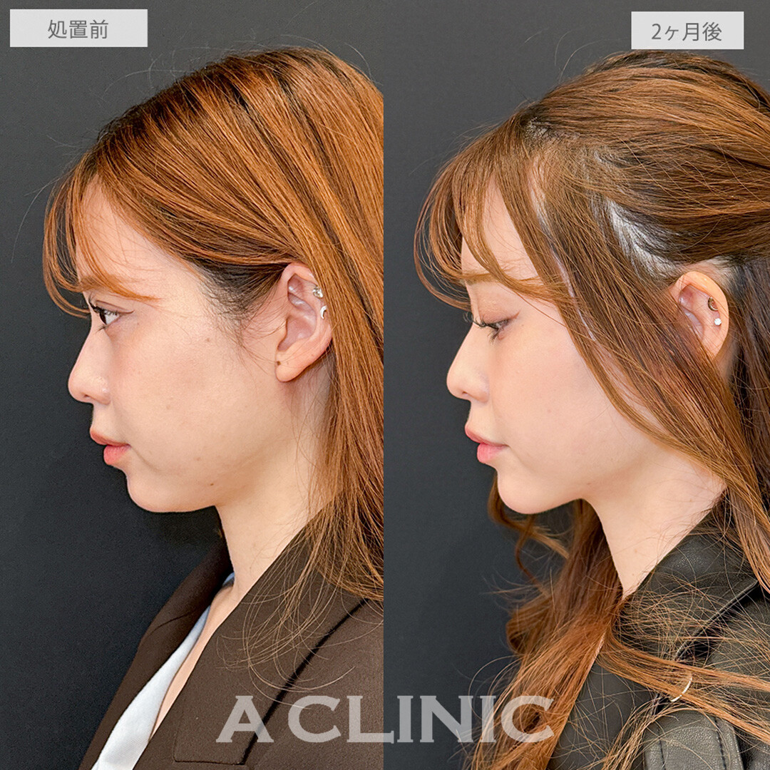 1day小顔脂肪吸引とあごへのヒアルロン酸注入で横顔のコンプレックス解消！こちら処置前と2ヶ月後の症例です(20代女性)