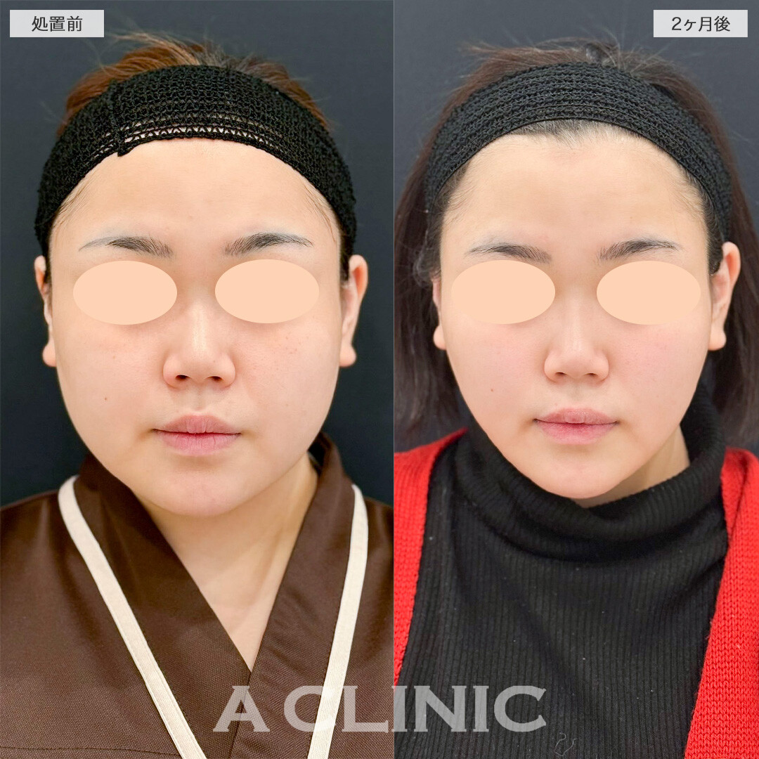 1day小顔脂肪吸引で下顔面のボリューム感が解消されました！処置前と2ヶ月後の症例です(20代女性)