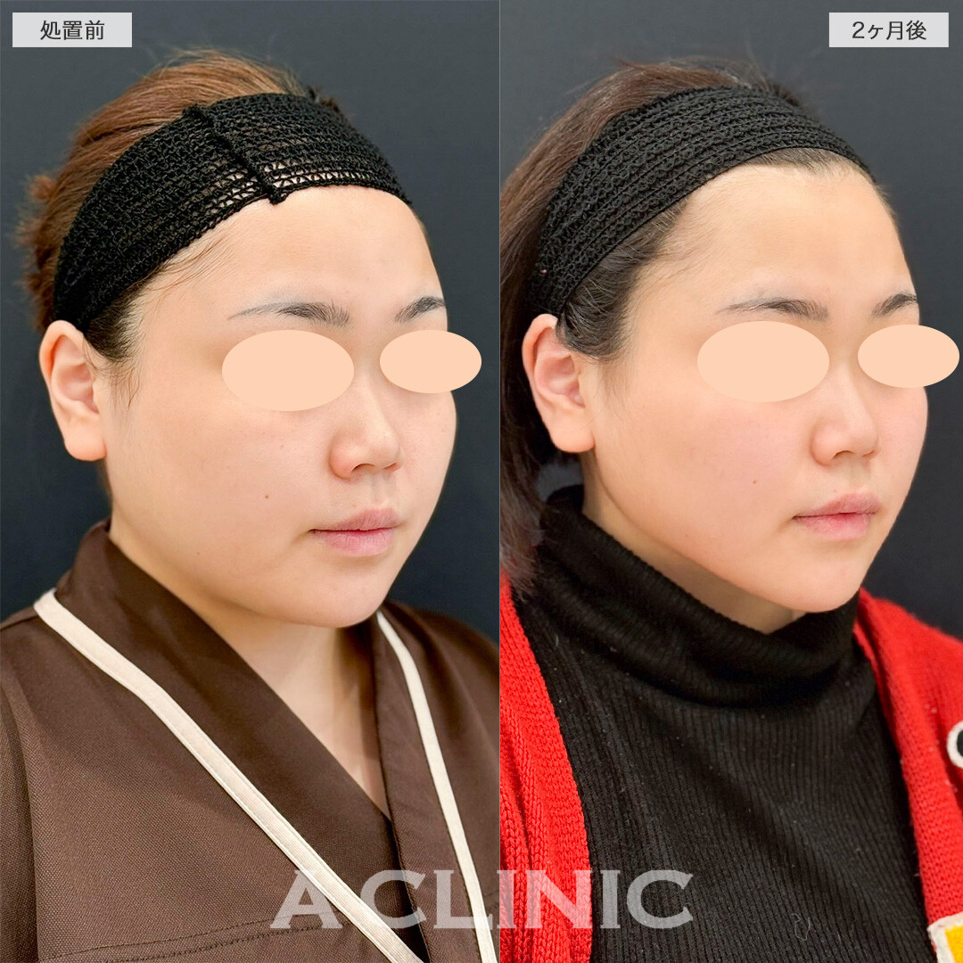 1day小顔脂肪吸引で下顔面のボリューム感が解消されました！処置前と2ヶ月後の症例です(20代女性)