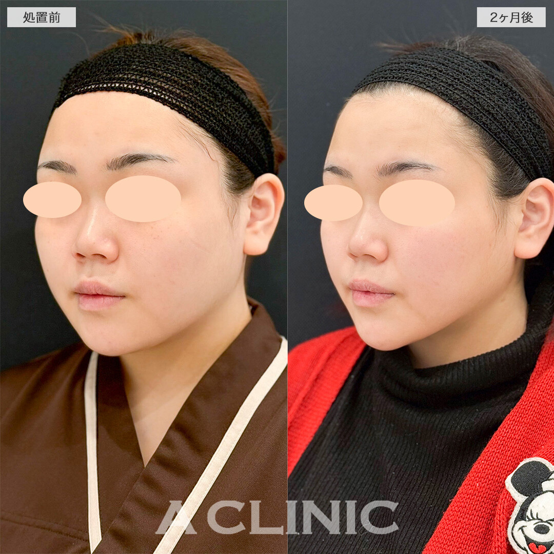 1day小顔脂肪吸引で下顔面のボリューム感が解消されました！処置前と2ヶ月後の症例です(20代女性)