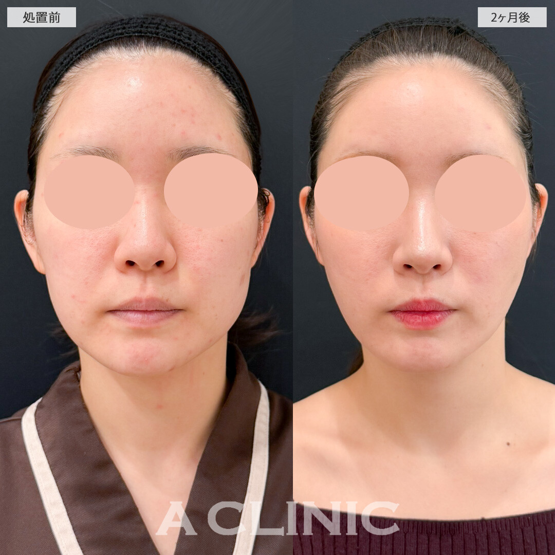 1day小顔脂肪吸引とバッカルファット除去術や頬へのヒアルロン酸注入の組み合わせ技で輪郭のバランスを整えました！処置前と2ヶ月後の症例です(30代女性)
