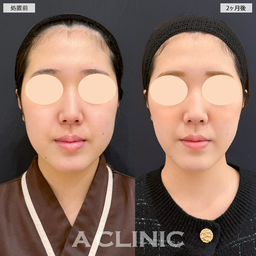 1day小顔脂肪吸引とバッカルファット除去術でボリュームのあるお顔の脂肪もスッキリさせました！処置前と2ヶ月後の症例です(20代女性)