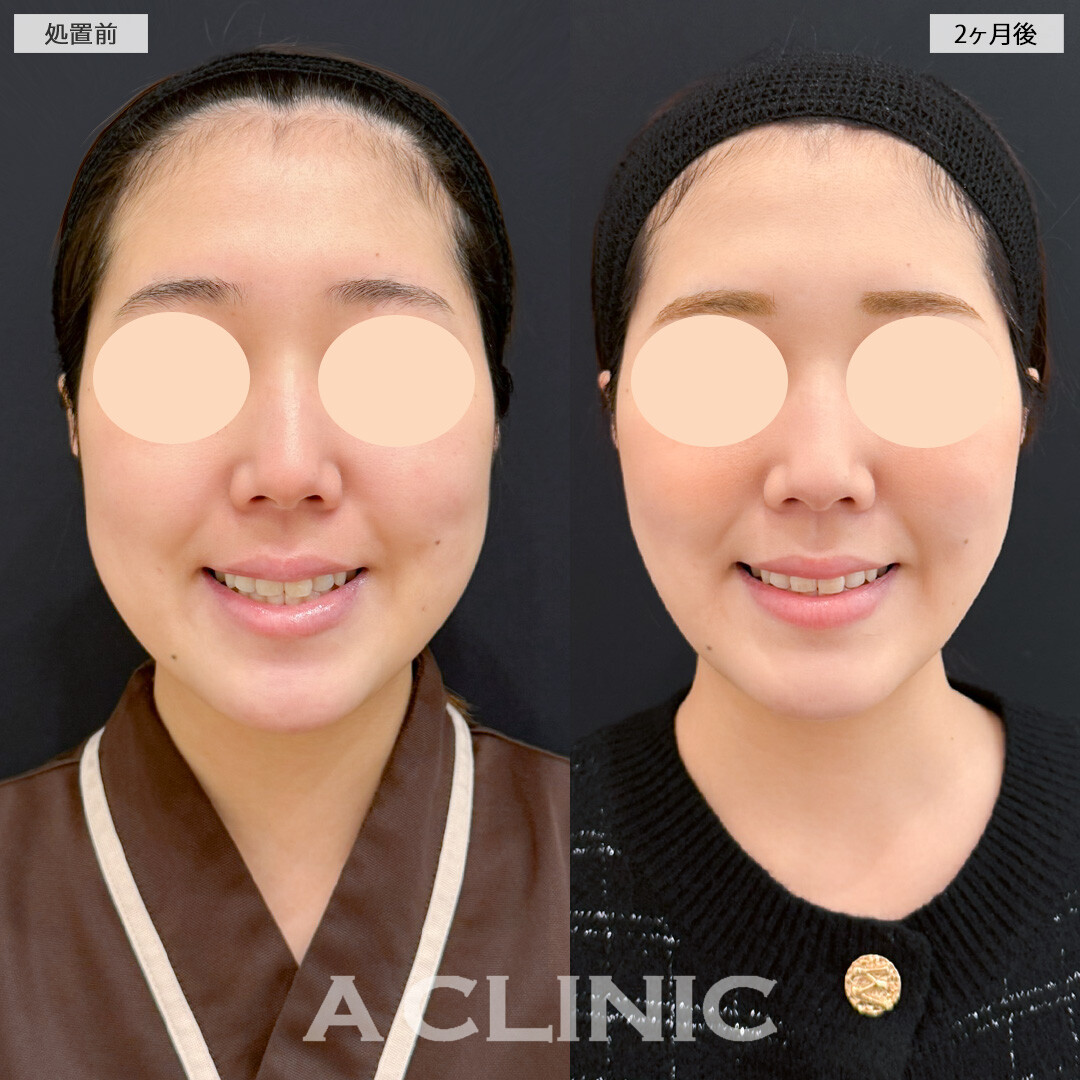 1day小顔脂肪吸引とバッカルファット除去術でボリュームのあるお顔の脂肪もスッキリさせました！処置前と2ヶ月後の症例です(20代女性)