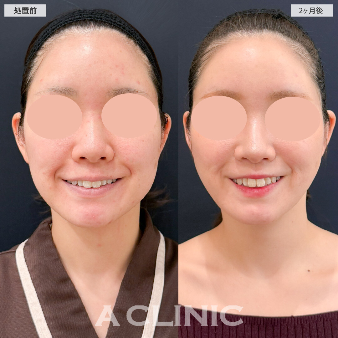 1day小顔脂肪吸引とバッカルファット除去術や頬へのヒアルロン酸注入の組み合わせ技で輪郭のバランスを整えました！処置前と2ヶ月後の症例です(30代女性)