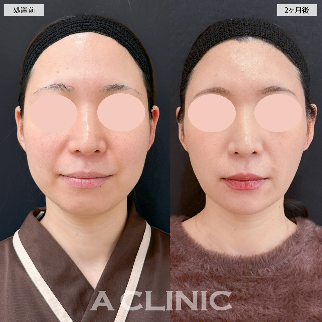 1day小顔脂肪吸引とバッカルファット除去術とあごへのヒアルロン酸注入で女性らしい輪郭にアップデート！処置前と2ヶ月後の症例です(30代女性)