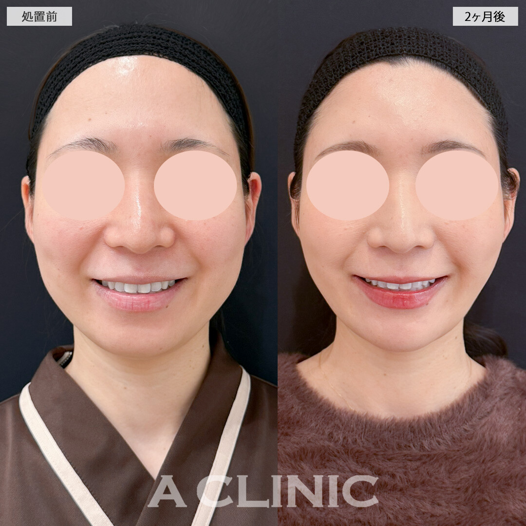 1day小顔脂肪吸引とバッカルファット除去術とあごへのヒアルロン酸注入で女性らしい輪郭にアップデート！処置前と2ヶ月後の症例です(30代女性)