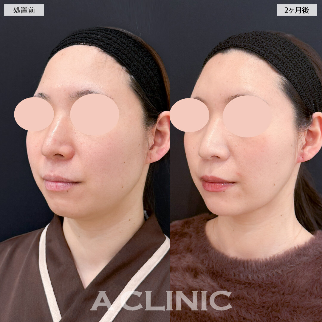 1day小顔脂肪吸引とバッカルファット除去術とあごへのヒアルロン酸注入で女性らしい輪郭にアップデート！処置前と2ヶ月後の症例です(30代女性)