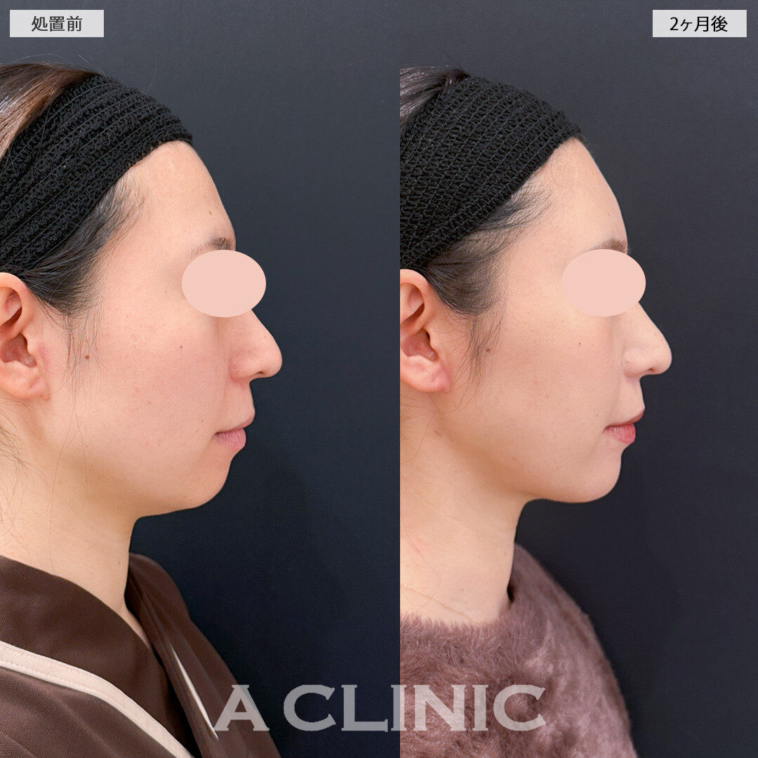 1day小顔脂肪吸引とバッカルファット除去術とあごへのヒアルロン酸注入で女性らしい輪郭にアップデート！処置前と2ヶ月後の症例です(30代女性)