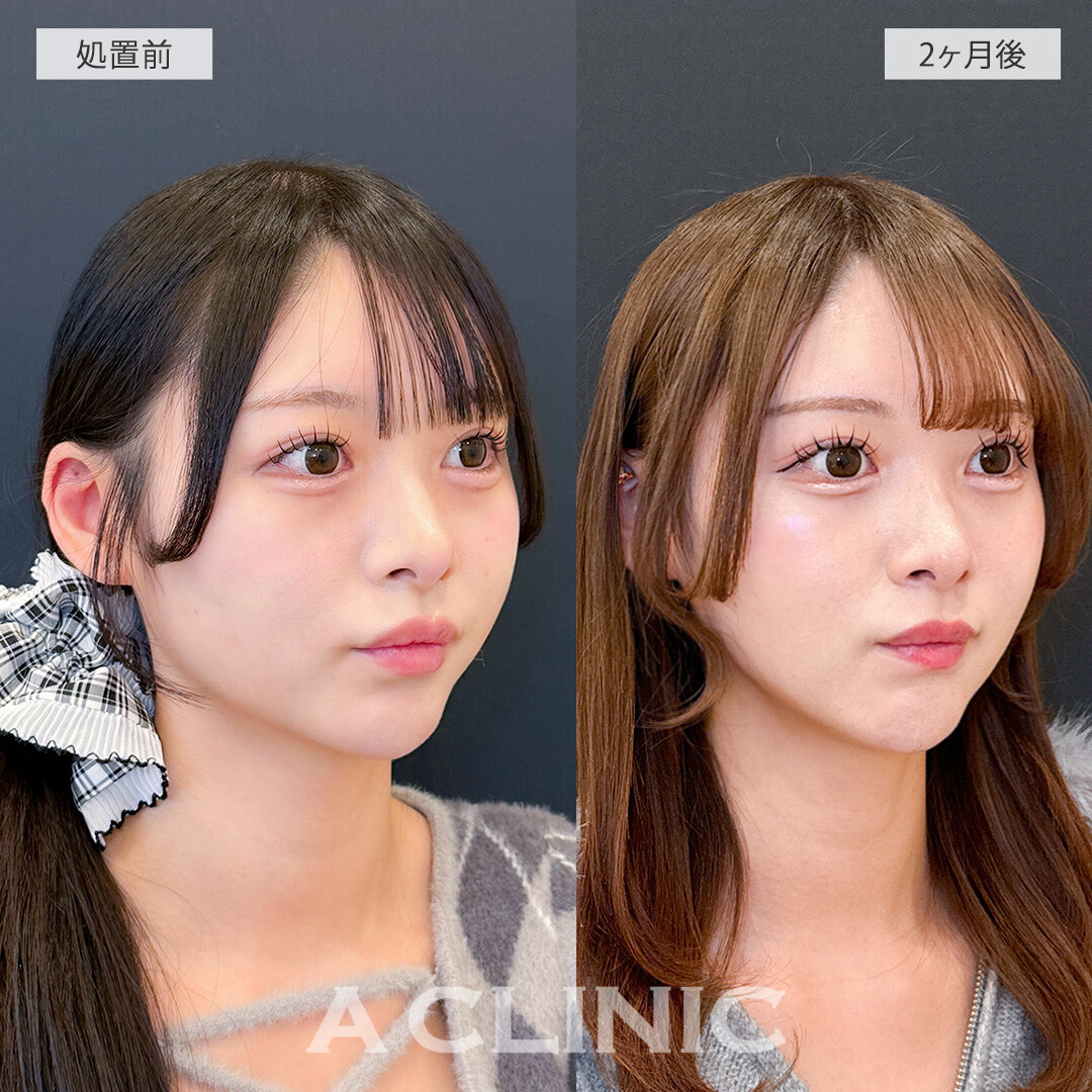 ハッキリしたフェイスラインになり垢抜けました！1day小顔脂肪吸引の処置前と2ヶ月後の症例です(20代女性)