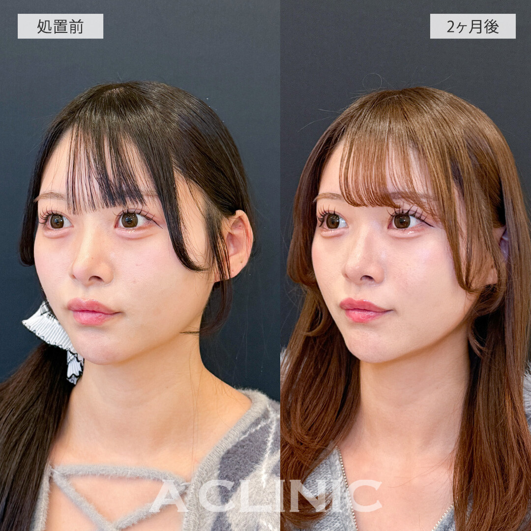 ハッキリしたフェイスラインになり垢抜けました！1day小顔脂肪吸引の処置前と2ヶ月後の症例です(20代女性)