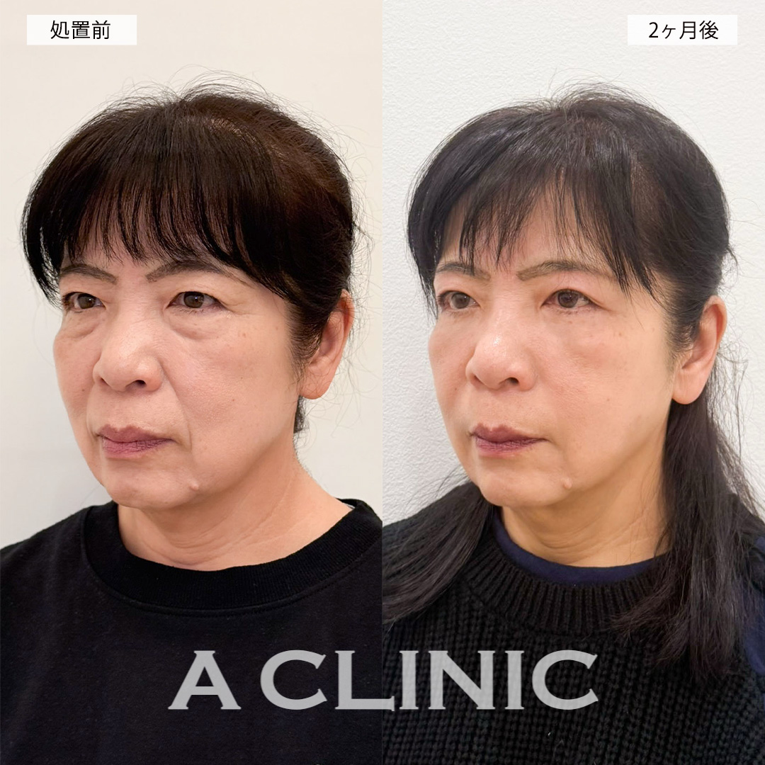 複合施術でお顔の印象が柔らかくなり自分に自信が持てるようになりました！処置前と2ヶ月後の症例です(60代女性)