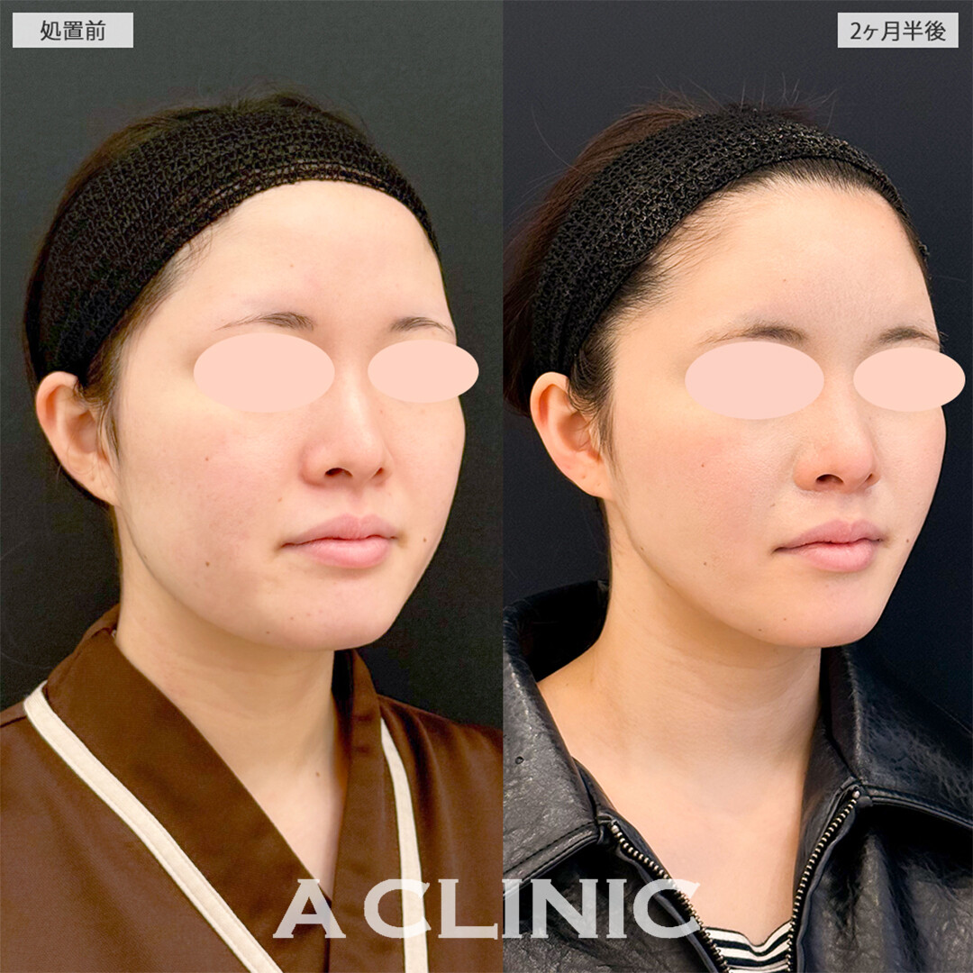 1day小顔脂肪吸引と小顔エラボトックスで一回り顔が小さくなりました！こちら処置前と2ヶ月半後の症例です(20代女性)