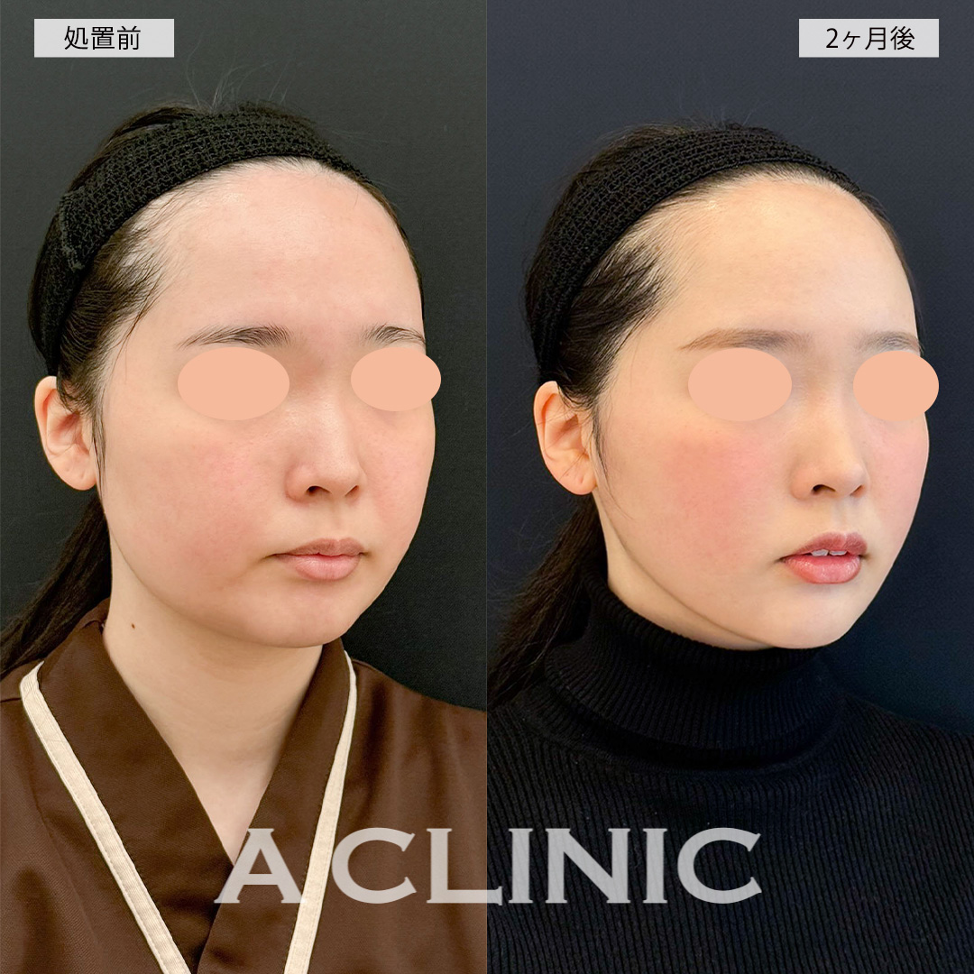 1day小顔脂肪吸引でお顔が一回り以上小さくなり自信が持てるようになりました！こちら処置前と2ヶ月後の症例です(20代女性)