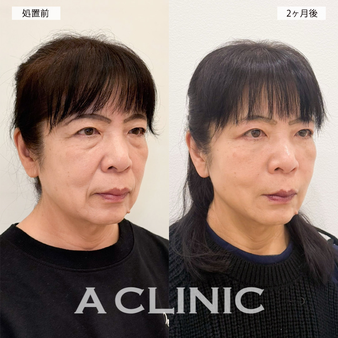 複合施術でお顔の印象が柔らかくなり自分に自信が持てるようになりました！処置前と2ヶ月後の症例です(60代女性)